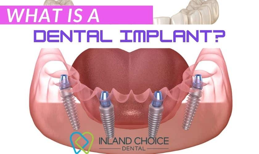 Implants Dentist Riverside