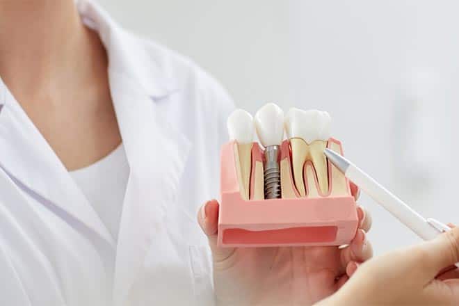 Dental Implants Riverside