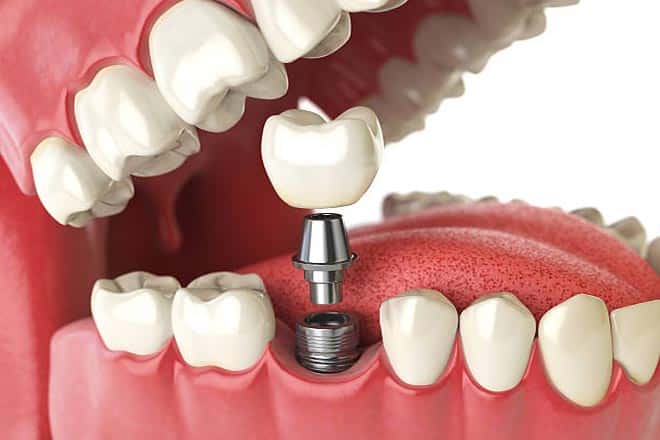 Dental Implants Riverside