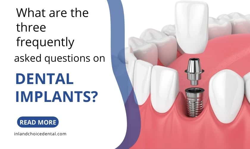 Featured image for “What are the three frequently asked questions on dental implants?”