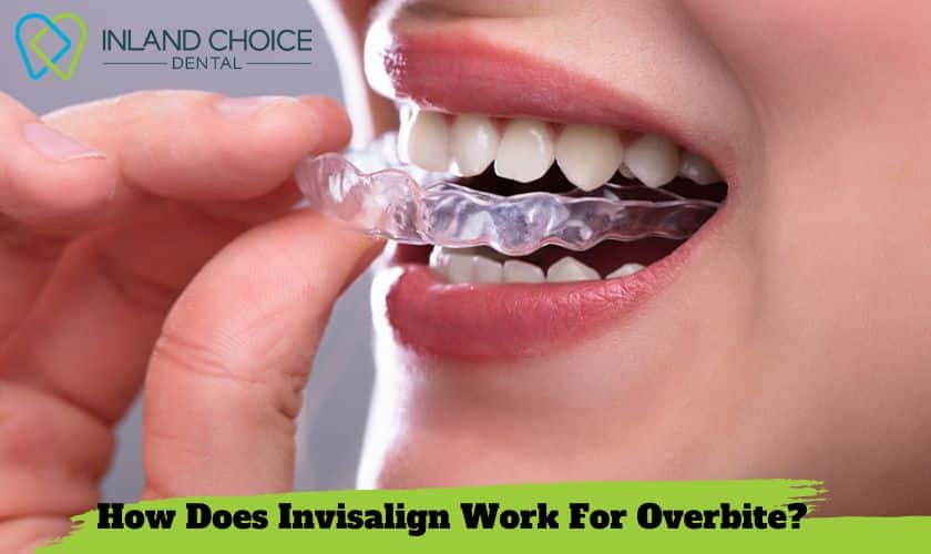 Featured image for “How Does Invisalign Work For Overbite?”