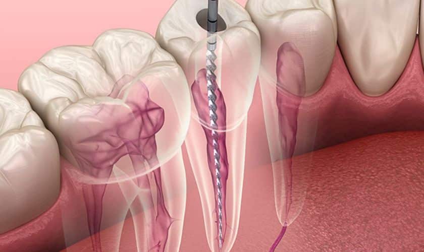 Symptoms-of-Root-Canals