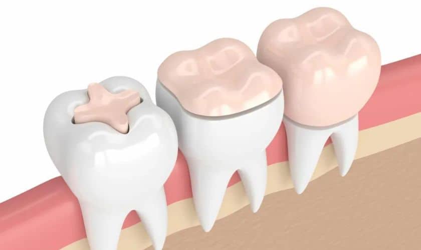 Featured image for “Dental Inlays vs Onlays: What’s the Difference and Which Is Right For You?”