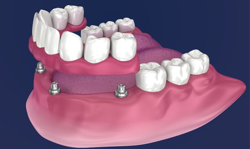 All-On-4 Dental Implants | Inland Choice Dental