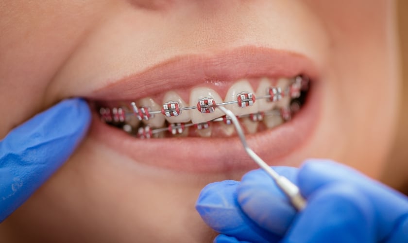 Can Dentists Fix Both Metal And Clear Braces | Inland Choice Dental