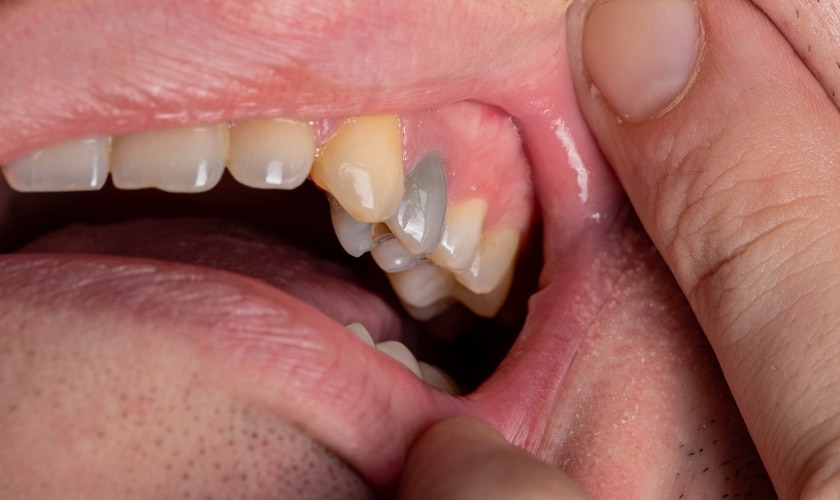 Is A Black Tooth An Emergency | Inland Choice Dental - Riverside Dentist