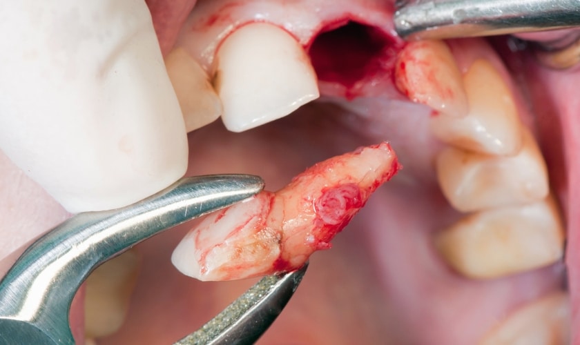 Can A Dentist Refuse To Extract A Tooth?