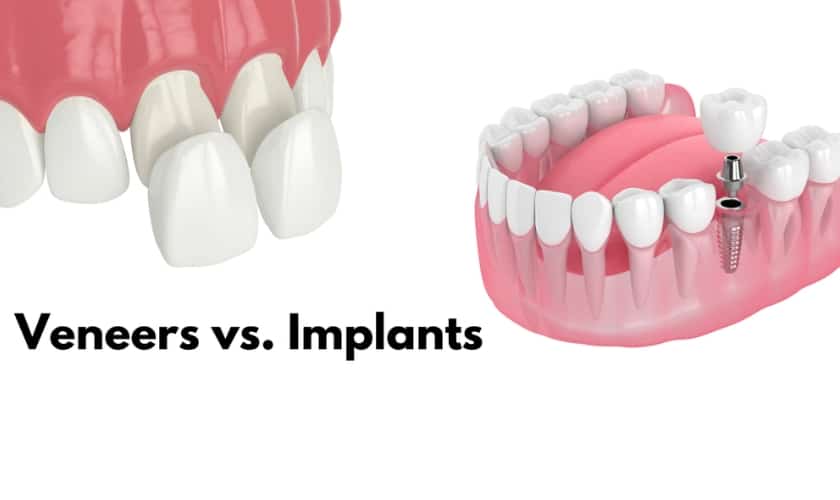 Featured image for “Which Looks Better: Veneers Or Implants?”