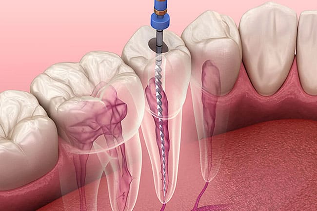 Root canals In Riverside , CA- Inland Choice Dental