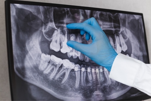 Dental Digital X Rays in Riverside CA | Inland Choice Dental- Riverside dentist
