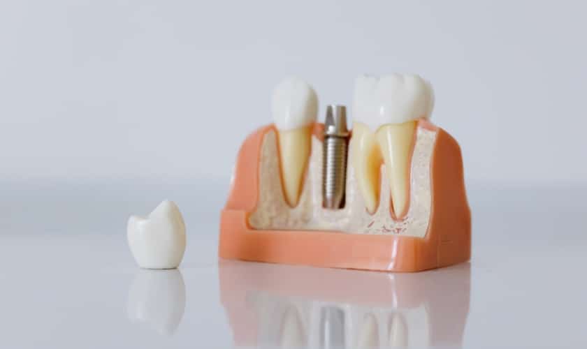 Dental implants in Riverside, CA- Inland Choice Dental - Riverside Dentist