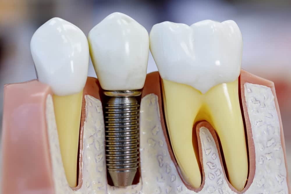 Implants Treatment in Riverside, CA | Inland Choice Dental