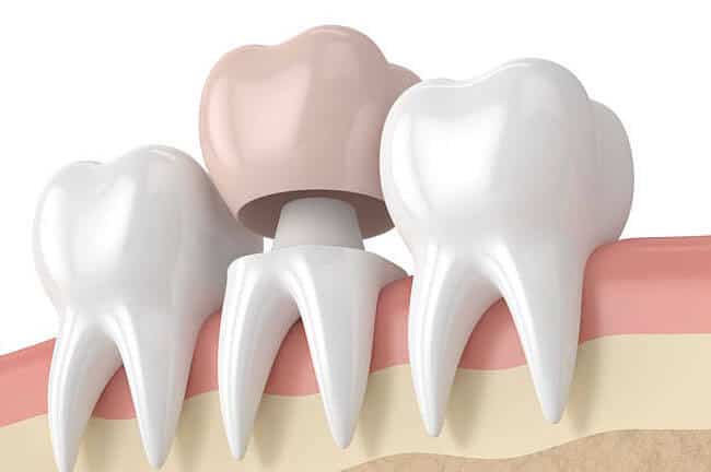 Porcelain Crowns in Riverside, CA | Inland Choice Dental- Dentist Riverside