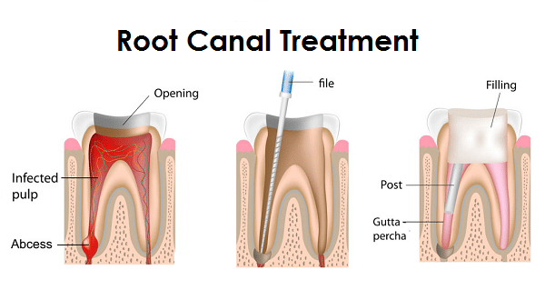 Root Canal Therapy in Riverside, CA | Inland Choice Dental- Riverside Dentist