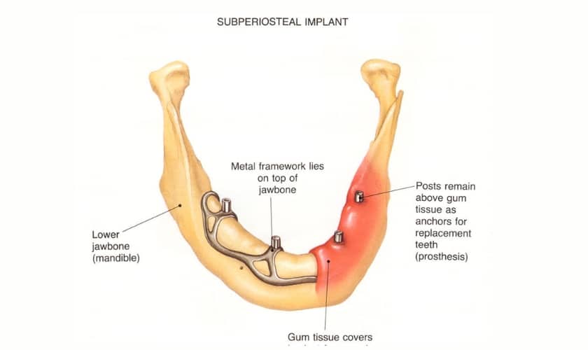 Subperiosteal Dental Implants in Riverside | Inland Choice Dental - Riverside Dentist