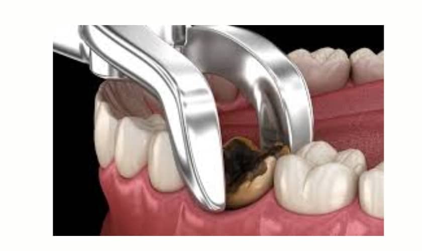 Tooth Extraction and Replacement in Riverside, CA | Inland Choice Dental - Riverside Dentist