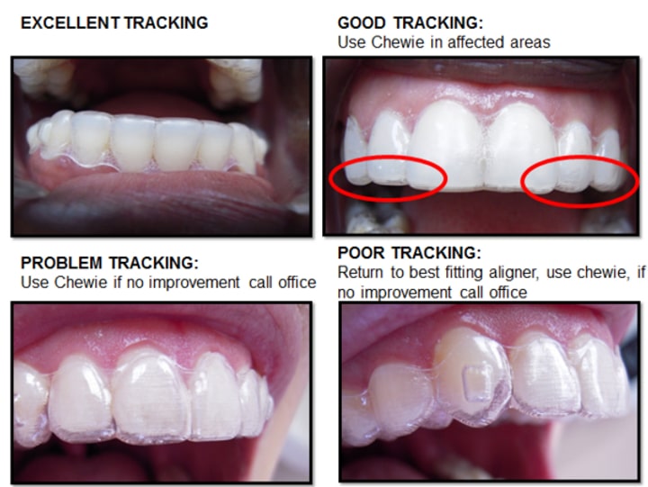 Tracking with Aligner at Inland Choice Dental - Riverside Dentist