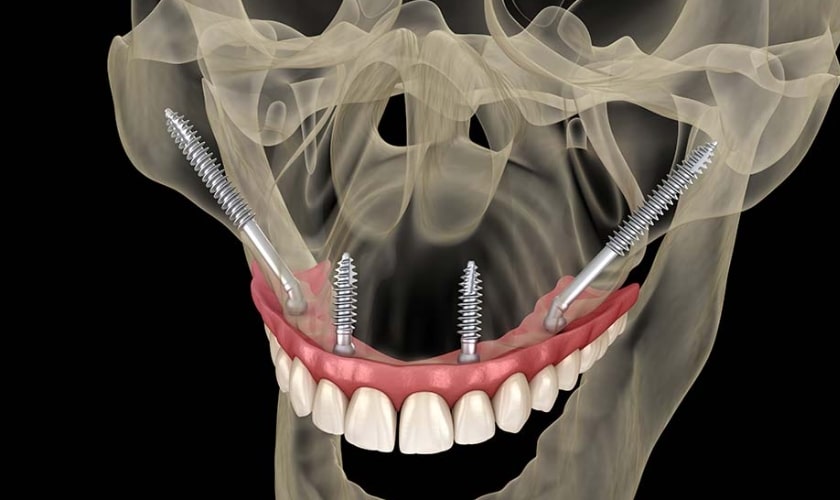 Zygomatic dental implants in Riverside- Inland Choice Dental