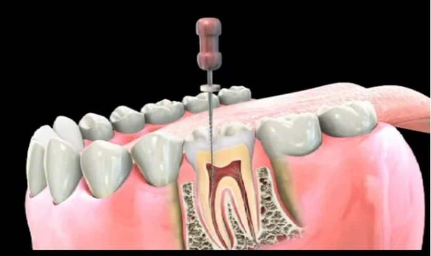 Featured image for “What is the Cause of Biting Pain After Root Canal?”