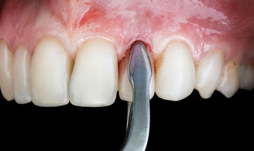 Close-up of gauze placed over a tooth extraction site to promote healing and control bleeding.