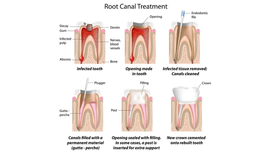 Root Canal treatment in Riverside - Inland Choice Dental