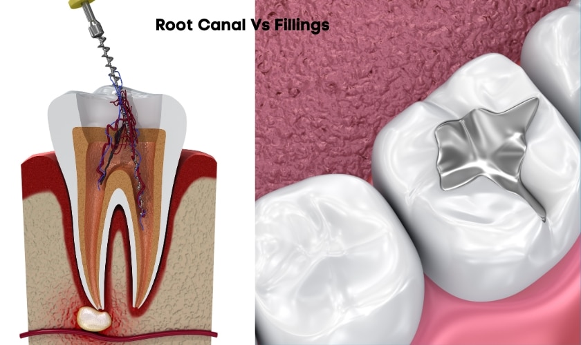 Root Canal VS fillings know the truth