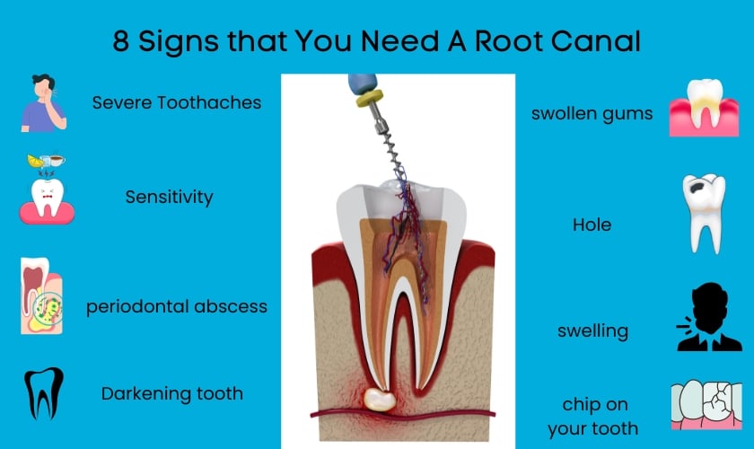Signs of Needing a root canal