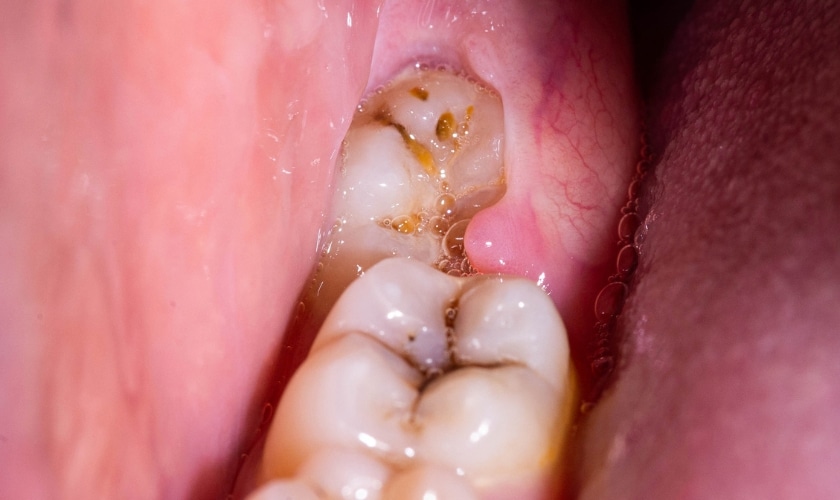 Wisdom Teeth Extraction in Riverisde