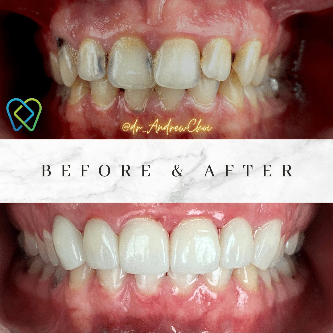 Before and after image displaying the results of cosmeti dentistry at Inland Choice Dental in Riverside.
