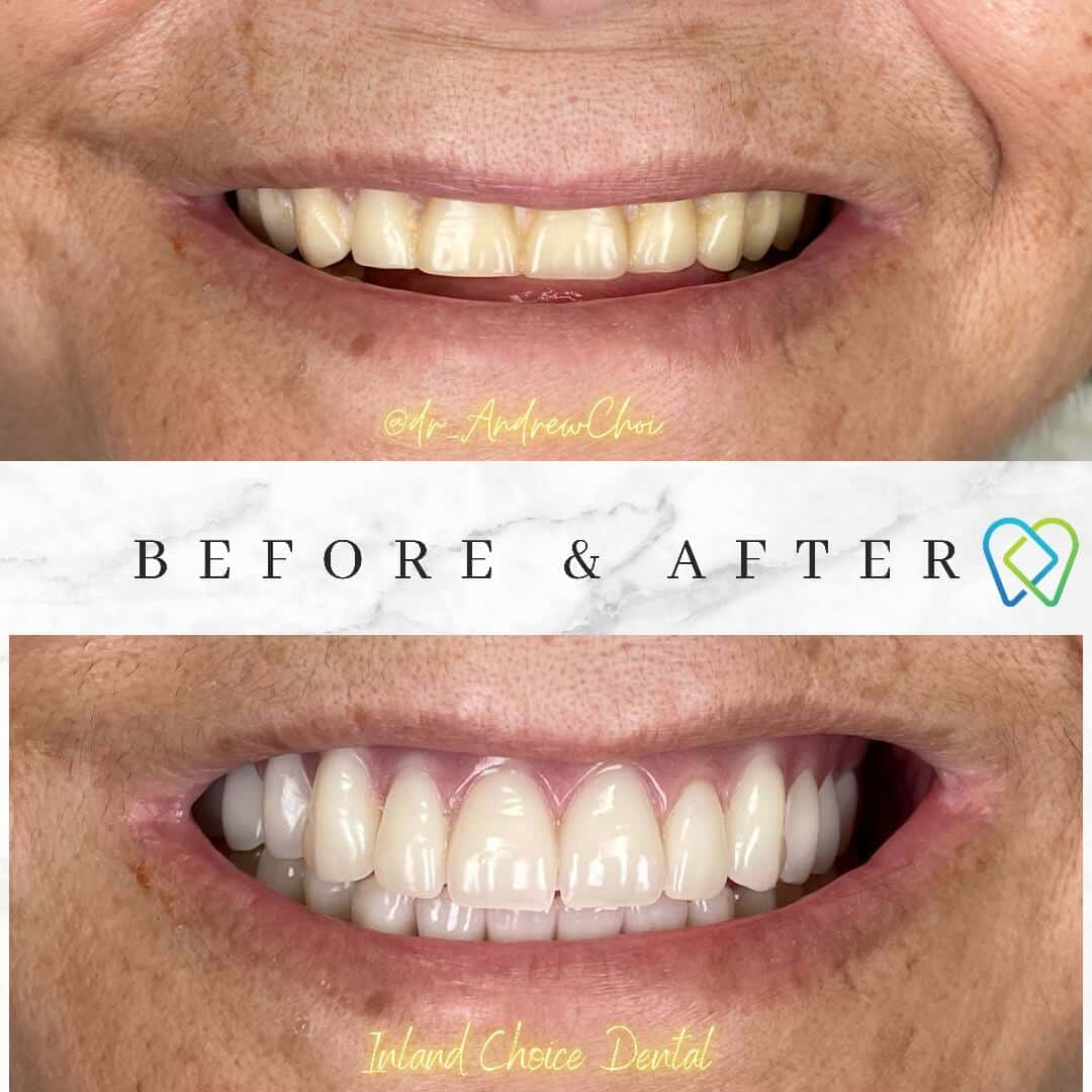 Before and after image highlighting cosmetic dentistry results at Inland Choice Dental in Riverside.