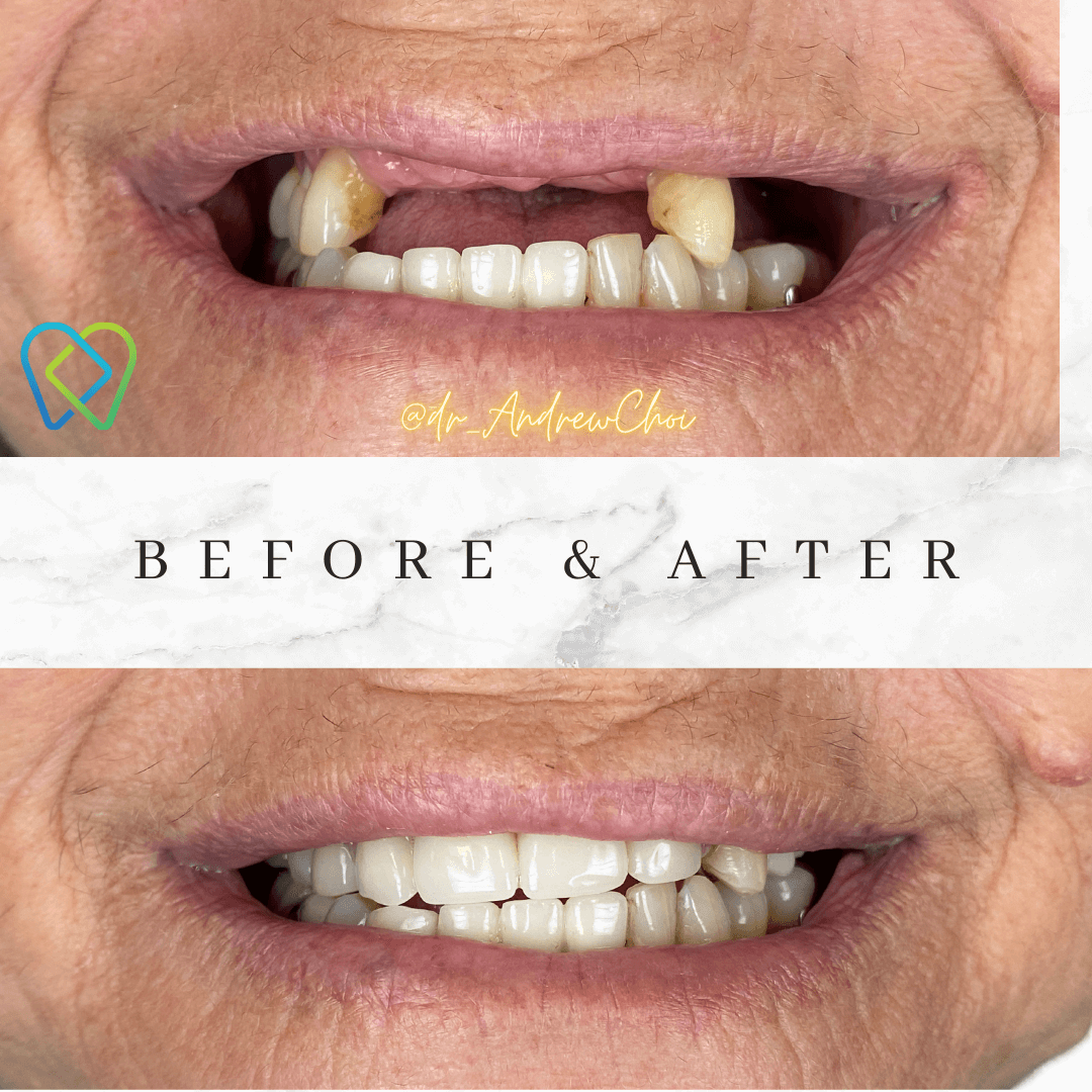 Before and after image showcasing dental implant results at Inland Choice Dental in Riverside.