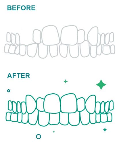 Before and after image of cosmetic dentistry treatment at Inland Choice Dental in Riverside.