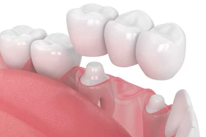 Dental crowns at Inland Choice Dental in Riverside, offering durable restorations for damaged or weakened teeth.