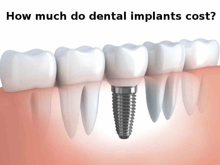 dental implants comprehensive guide 2024
