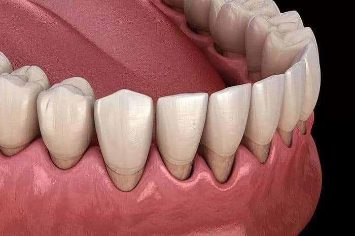 Gum contouring at Inland Choice Dental in Riverside, CA, providing aesthetic gum reshaping for a confident smile.