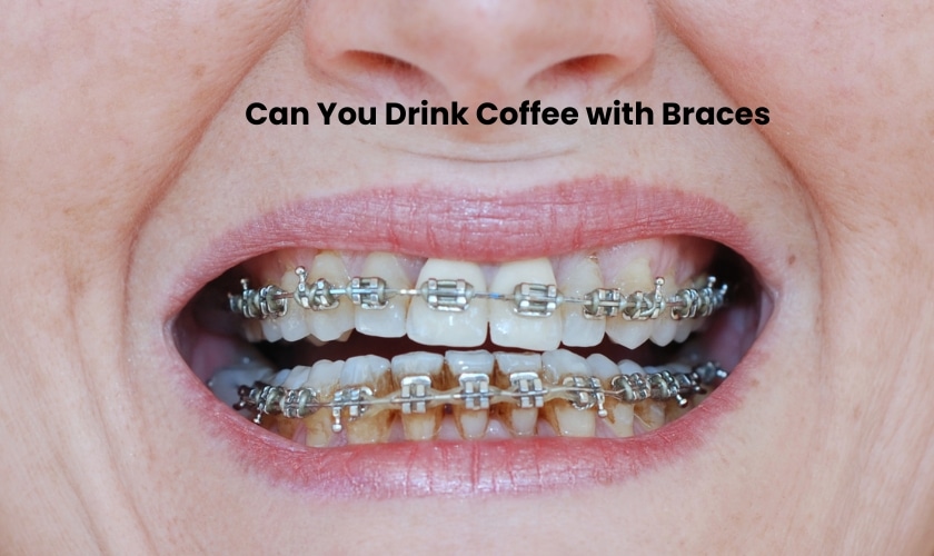 Can You Drink Coffee with Braces? - Inland Choice Dental