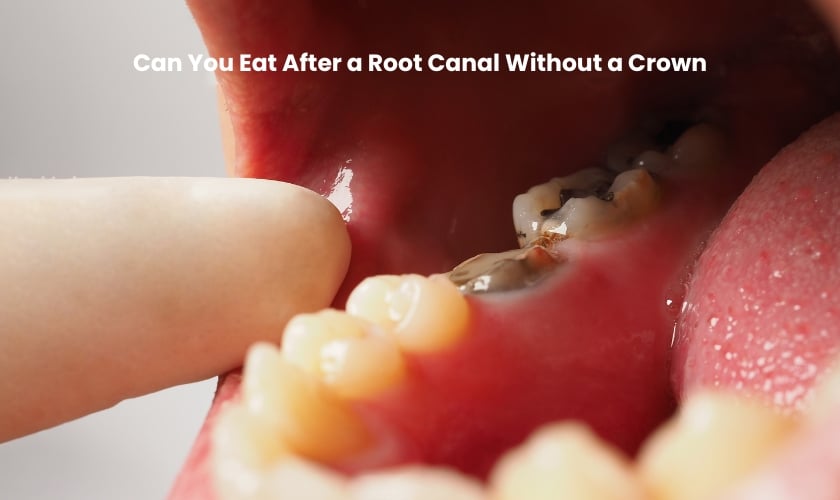Can You Eat After a Root canal Without Crown?