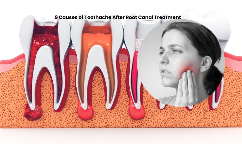 Featured image for “9 Causes of Toothache After Root Canal Treatment”