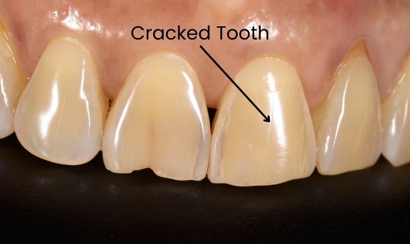 A Cracked Tooth Look Like - Inland Choice Dental