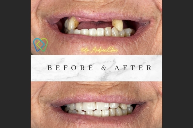 All dental Implants Riverside Your Smile Solution - Inland Choice Dental