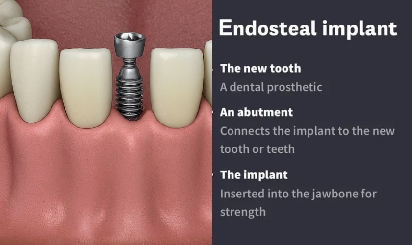 Endosteal Implants Riverside - Inland Choice Dental