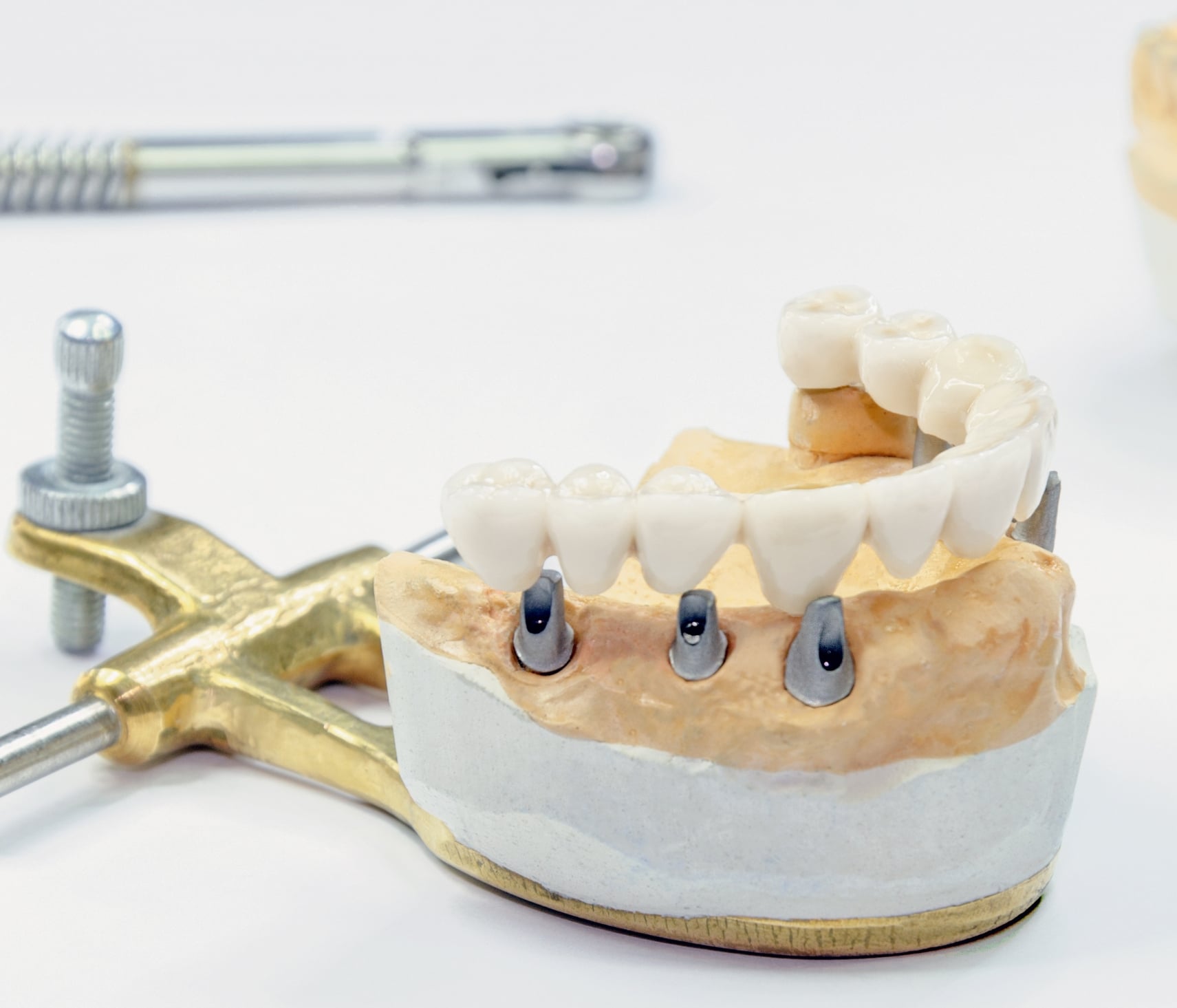 Ready to Regain Full Dental Implants Function?