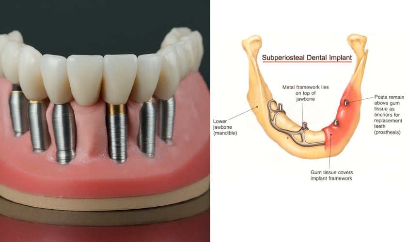 Subperiosteal Implant Riverside - Inland Choice Dental