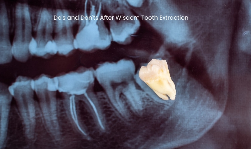 Do's and Don'ts After Wisdom Tooth Extraction