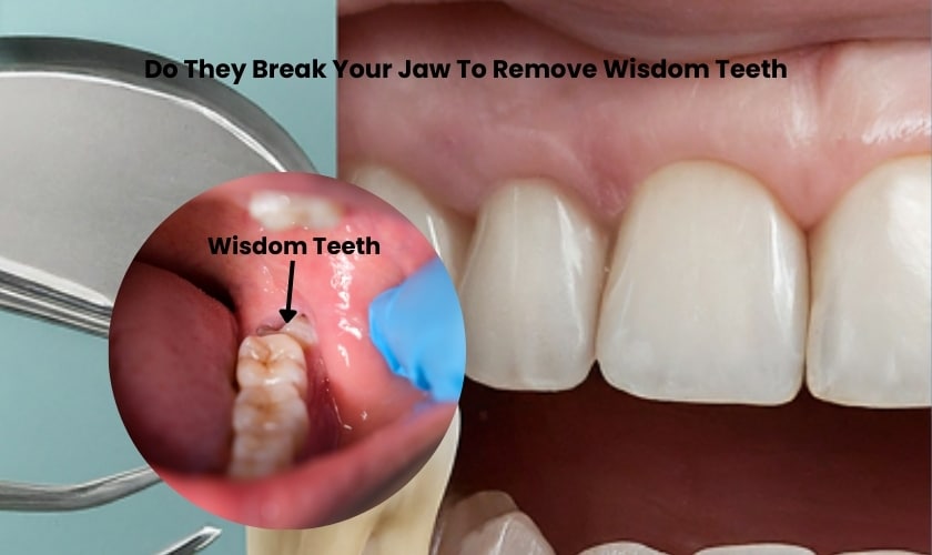 Featured image for “Do They Break Your Jaw To Remove Wisdom Teeth”