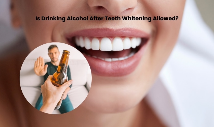 Featured image for “Is Drinking Alcohol After Teeth Whitening Allowed?”