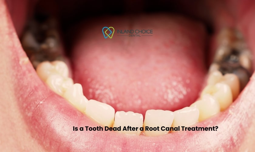 Is a Tooth Dead After a Root Canal Treatment?