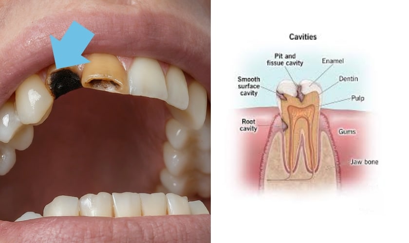 Featured image for “How To Avoid Cavity Pain”