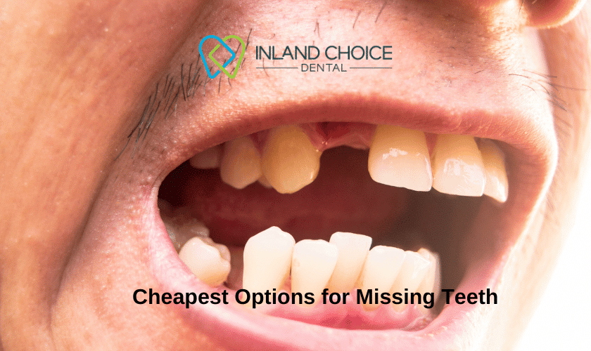 Featured image for “Exploring the Cheapest Options for Missing Teeth”