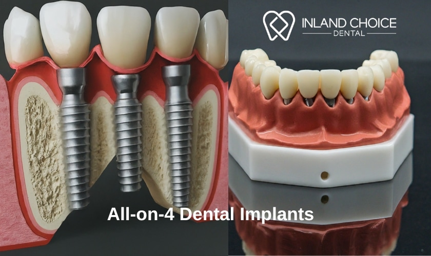 Featured image for “Pros and Cons of All-on-4 Dental Implants: A Comprehensive Guide”